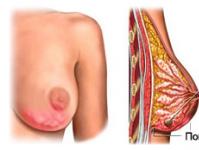 Як уникнути лактостазу при грудному вигодовуванні: профілактика захворювання Перші симптоми лактостазу
