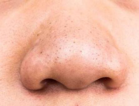 Як позбутися чорних крапок на носі?